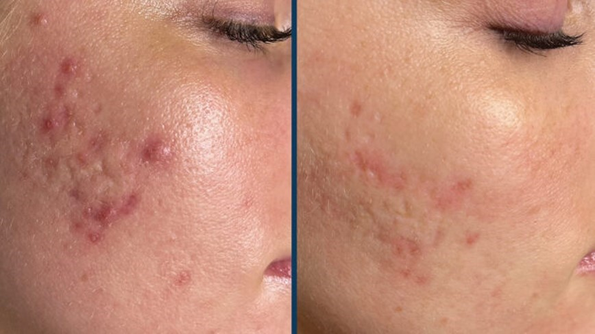 Acne and Exosomes